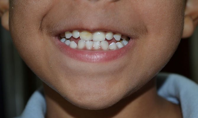 The American Academy of Pediatric Dentistry recommends that children wait until after they’ve received all of their permanent teeth before undergoing a cosmetic dental procedure.

