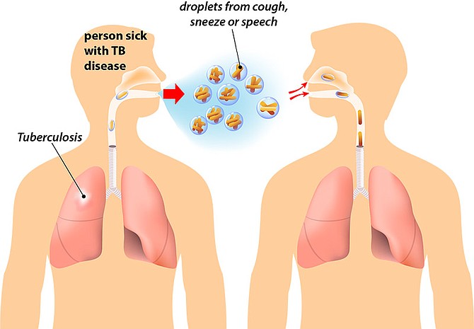 County health officials say TB is not the easiest disease to contract, especially from just casual contact, but persons with certain risk factors should be mindful that they could be “TB latent” without showing any symptoms or more likely to get active tuberculosis. Only testing can determine a person’s TB status.